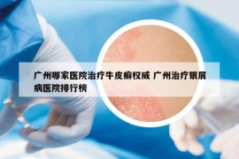 廣州哪家醫(yī)院治療牛皮癬權(quán)威 廣州治療銀屑病醫(yī)院排行榜