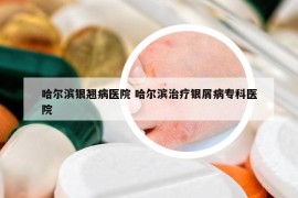 哈爾濱銀翹病醫(yī)院 哈爾濱治療銀屑病專科醫(yī)院