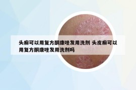 頭癬可以用復(fù)方酮康唑發(fā)用洗劑 頭皮癬可以用復(fù)方酮康唑發(fā)用洗劑嗎
