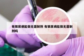 有銀屑病能做無菌制劑 有銀屑病能做無菌制劑嗎