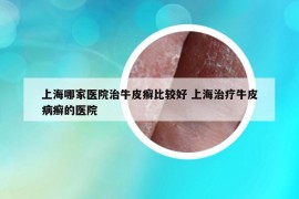 上海哪家醫(yī)院治牛皮癬比較好 上海治療牛皮病癬的醫(yī)院