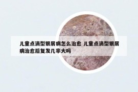 兒童點(diǎn)滴型銀屑病怎么治愈 兒童點(diǎn)滴型銀屑病治愈后復(fù)發(fā)幾率大嗎