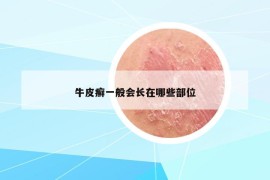 牛皮癬一般會長在哪些部位