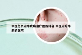 中醫(yī)怎么治牛皮癬治療醫(yī)院排名 中醫(yī)治療牛癬的醫(yī)院