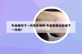 牛皮癬對下一代有影響嗎 牛皮膚癬會影響下一代嗎?