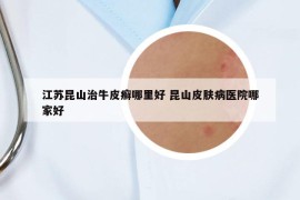 江蘇昆山治牛皮癬哪里好 昆山皮膚病醫(yī)院哪家好