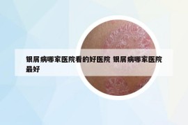 銀屑病哪家醫(yī)院看的好醫(yī)院 銀屑病哪家醫(yī)院最好
