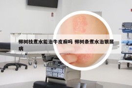 柳樹枝煮水能治牛皮癬嗎 柳樹條煮水治銀屑病