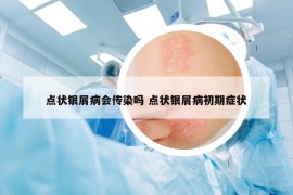 點(diǎn)狀銀屑病會(huì)傳染嗎 點(diǎn)狀銀屑病初期癥狀