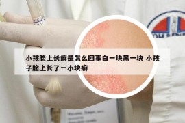 小孩臉上長(zhǎng)癬是怎么回事白一塊黑一塊 小孩子臉上長(zhǎng)了一小塊癬