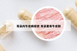 耳朵內(nèi)牛皮癬癥狀 耳朵里有牛皮鮮