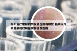 福州治療銀屑病的權(quán)威醫(yī)院有哪些 福州治療銀屑病的權(quán)威醫(yī)院有哪些醫(yī)院