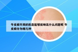 牛皮癬不同的形態(tài)能夠反映出什么問題呢 牛皮癬分為哪幾種