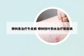 柳樹條治療牛皮癬 柳樹枝葉熬水治療銀屑病
