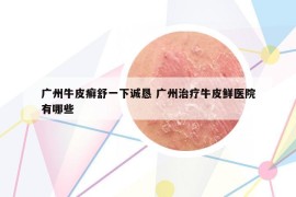 廣州牛皮癬舒一下誠(chéng)懇 廣州治療牛皮鮮醫(yī)院有哪些