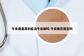 牛皮康是真的能治牛皮癬嗎 牛皮廨百度百科