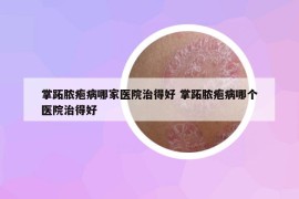 掌跖膿皰病哪家醫(yī)院治得好 掌跖膿皰病哪個(gè)醫(yī)院治得好