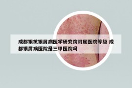 成都銀抗銀屑病醫(yī)學研究院附屬醫(yī)院等級 成都銀屑病醫(yī)院是三甲醫(yī)院嗎