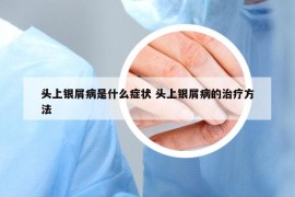頭上銀屑病是什么癥狀 頭上銀屑病的治療方法