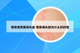 銀屑病發(fā)展到頭面 銀屑病頭部為什么好的慢