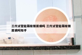 三代試管能篩除銀屑病嗎 三代試管能篩除銀屑病嗎知乎