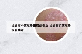 成都哪個(gè)醫(yī)院看銀屑病專(zhuān)業(yè) 成都哪家醫(yī)院看銀屑病好