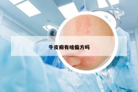 牛皮癬有啥偏方嗎
