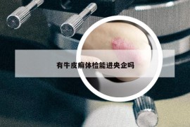 有牛皮癬體檢能進(jìn)央企嗎