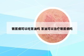 銀屑病可以吃茶油嗎 茶油可以治療銀屑病嗎