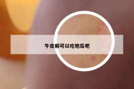 牛皮癬可以吃地瓜吧