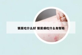 銀屑吃什么好 銀屑病吃什么有幫助