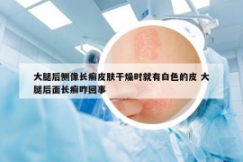 大腿后側(cè)像長(zhǎng)癬皮膚干燥時(shí)就有白色的皮 大腿后面長(zhǎng)癬咋回事