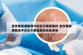 急性銀屑病輸液中還在不斷冒新的 急性銀屑病輸液中還在不斷冒新的白色液體