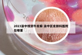 2023渝中樓到牛皮癬 渝中區(qū)皮膚科醫(yī)院在哪里