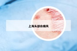 上海頭部白癜風