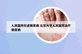 人民醫(yī)院引進銀屑病 北京大學人民醫(yī)院治療銀屑病