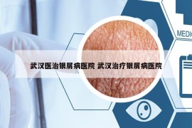 武漢醫(yī)治銀屑病醫(yī)院 武漢治療銀屑病醫(yī)院