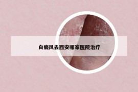 白癜風(fēng)去西安哪家醫(yī)院治療