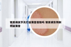 銀屑病關節(jié)炎打益賽普報銷嗎 銀屑病生物制劑益賽普