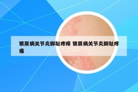 銀屑病關(guān)節(jié)炎腳趾疼癢 銀屑病關(guān)節(jié)炎腳趾疼痛