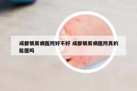 成都銀屑病醫(yī)院好不好 成都銀屑病醫(yī)院真的能醫(yī)嗎