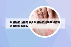 銀屑顆粒價(jià)格是多少銀屑顆粒的功效和作用 銀屑顆粒有用嗎
