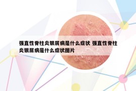 強直性脊柱炎銀屑病是什么癥狀 強直性脊柱炎銀屑病是什么癥狀圖片