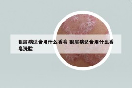銀屑病適合用什么香皂 銀屑病適合用什么香皂洗臉