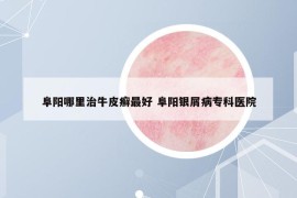 阜陽哪里治牛皮癬最好 阜陽銀屑病?？漆t(yī)院