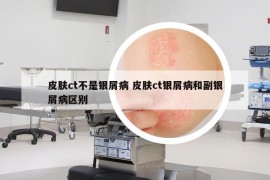 皮膚ct不是銀屑病 皮膚ct銀屑病和副銀屑病區(qū)別