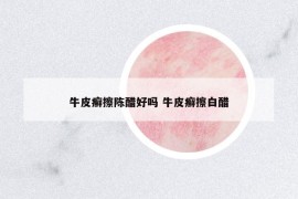牛皮癬擦陳醋好嗎 牛皮癬擦白醋