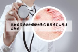 患有銀屑病能吃保健魚類嗎 銀屑病的人可以吃魚嗎