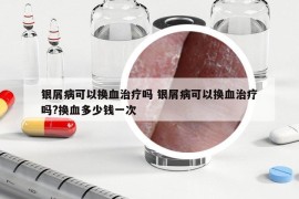 銀屑病可以換血治療嗎 銀屑病可以換血治療嗎?換血多少錢一次