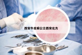 西安牛皮癬公立西安北方